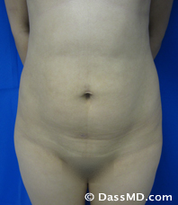 Patient #6116 Buttock Lift/Augmentation Before and After Photos