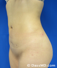 Patient #6102 Buttock Lift/Augmentation Before and After Photos