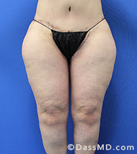 Thigh Lift Surgery Before and After Photos Beverly Hills