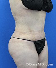 Tummy Tuck Los Angeles  Beverly Hills Abdominoplasty