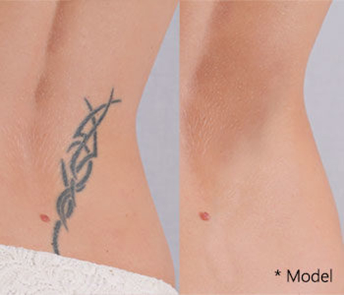 Laser Tattoo Removal  PicoSure by CYNOSURE  Chicago IL