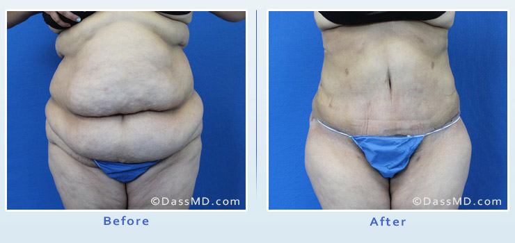 Tummy Tuck Revision and Repair by Beverly Hills Female Plastic