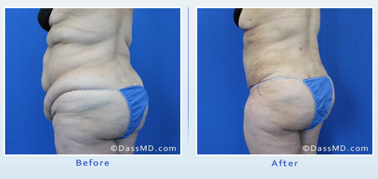 Best Bra Fat Liposuction Los Angeles & Beverly Hills