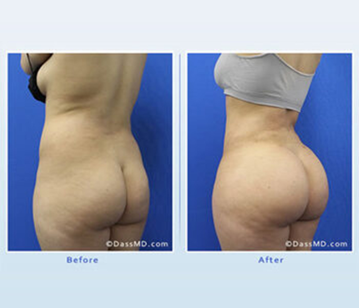 Brazilian Butt Lift Surgery Beverly Hills CA - What To Expect