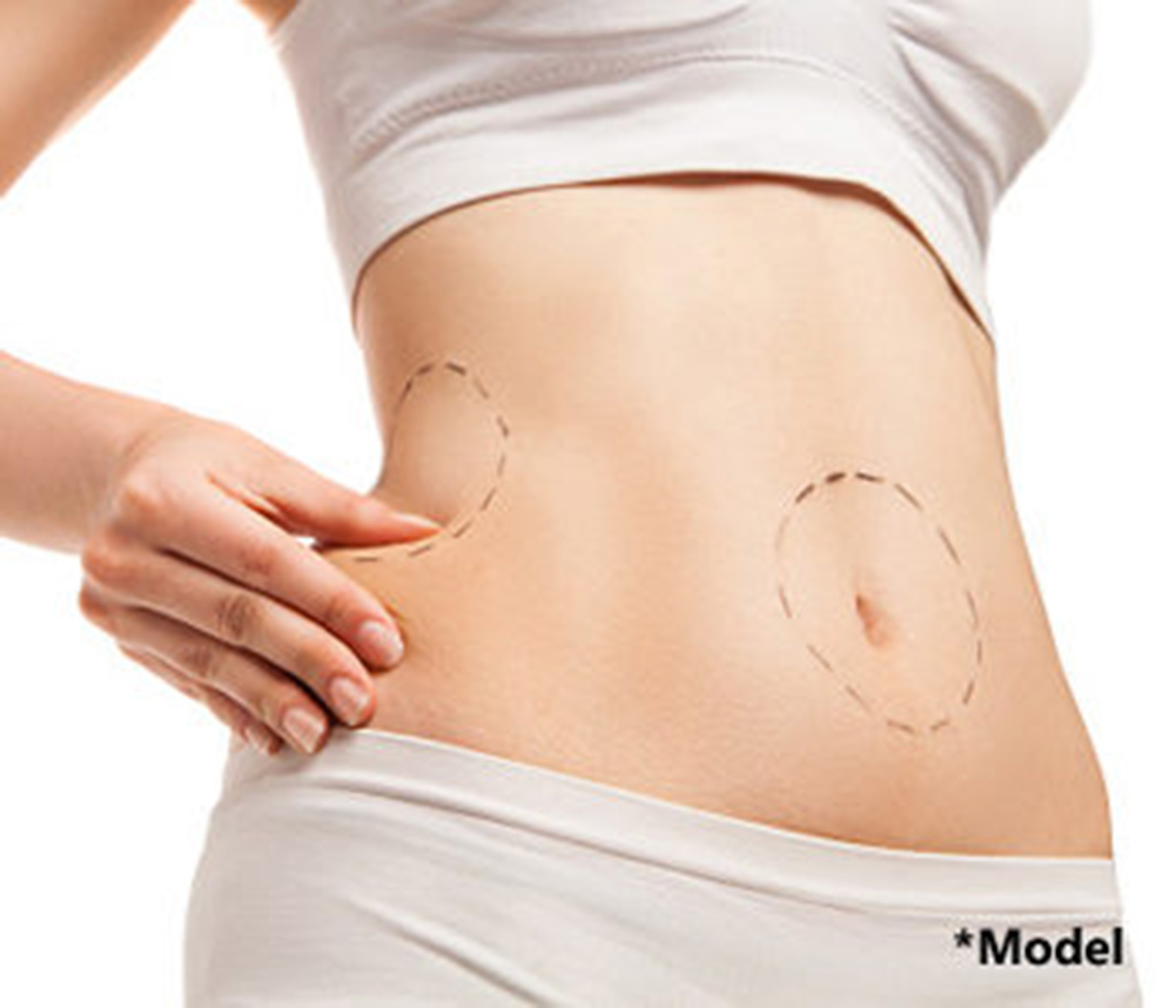 Tummy Tuck Plastic Surgery in Beverly Hills - Lose Belly Fat