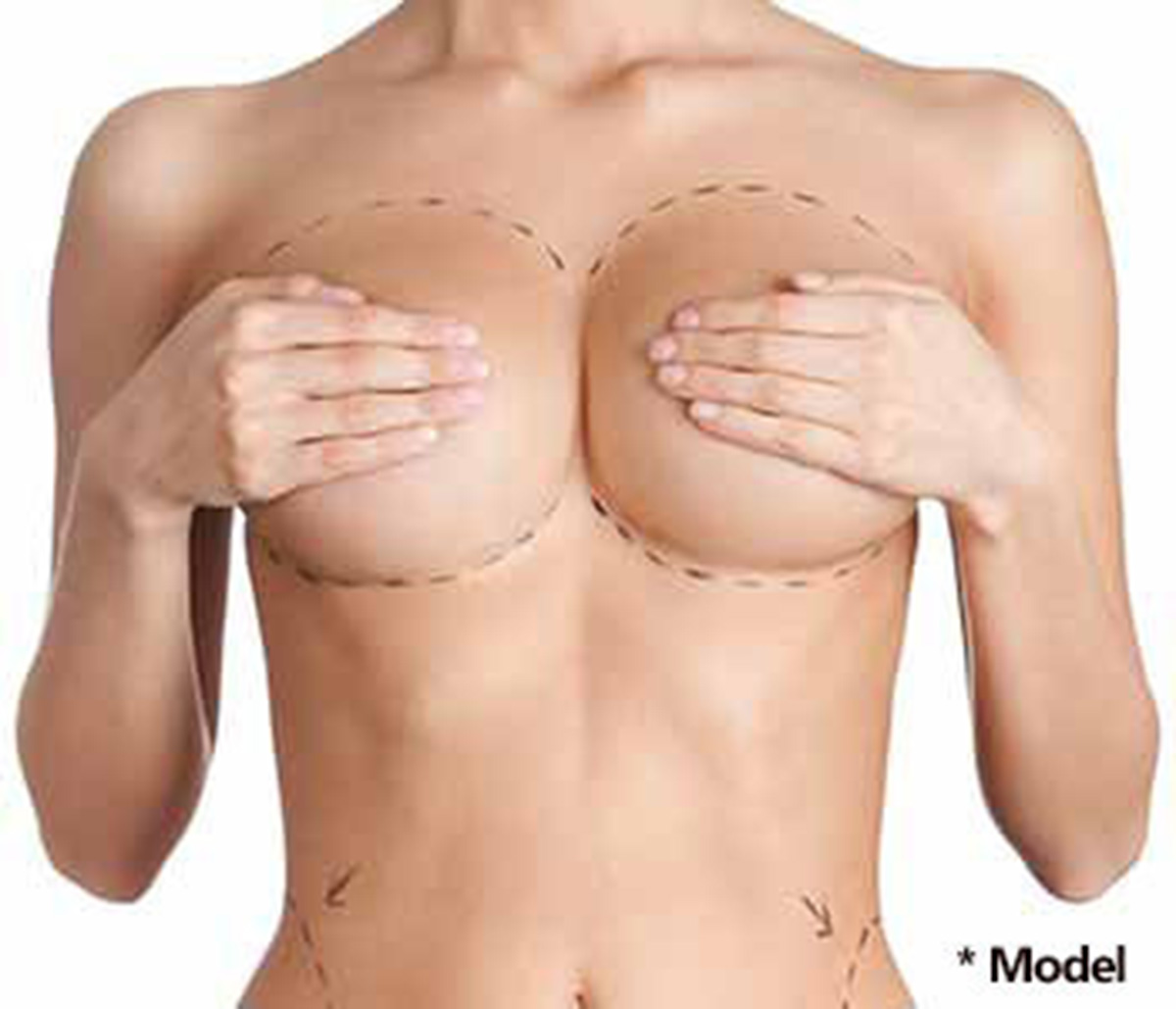 Types of Sagging & When to Consider a Breast Lift in Beverly Hills