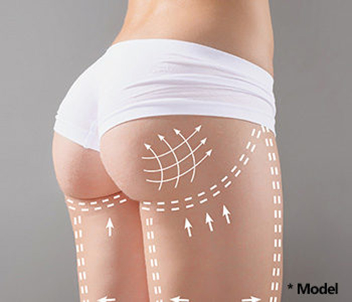 Butt Augmentation Los Angeles - Butt Implants - Gluteal Implant