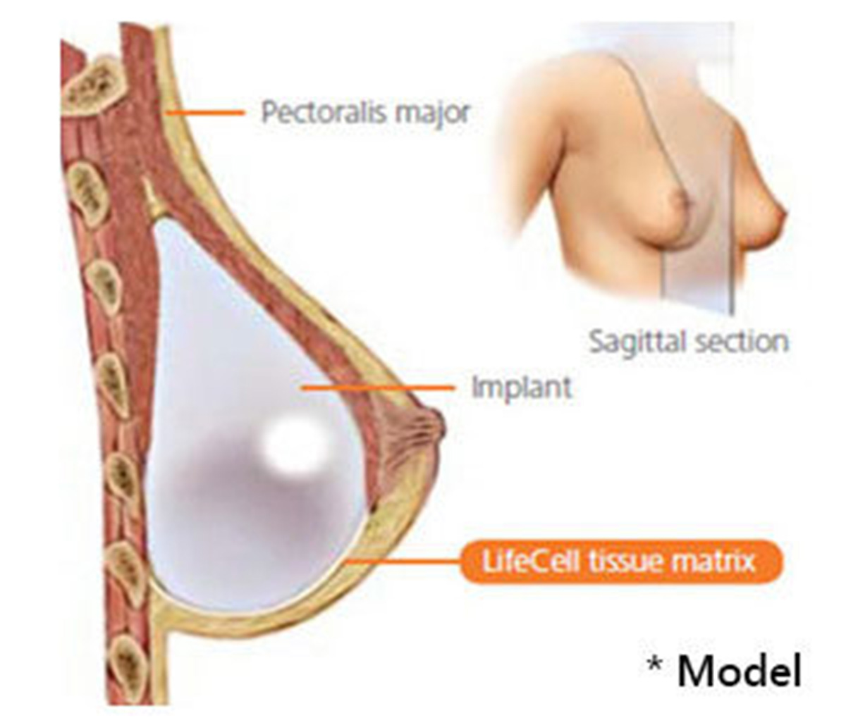 Fix Breast Implants Los Angeles - Internal bra with Strattice