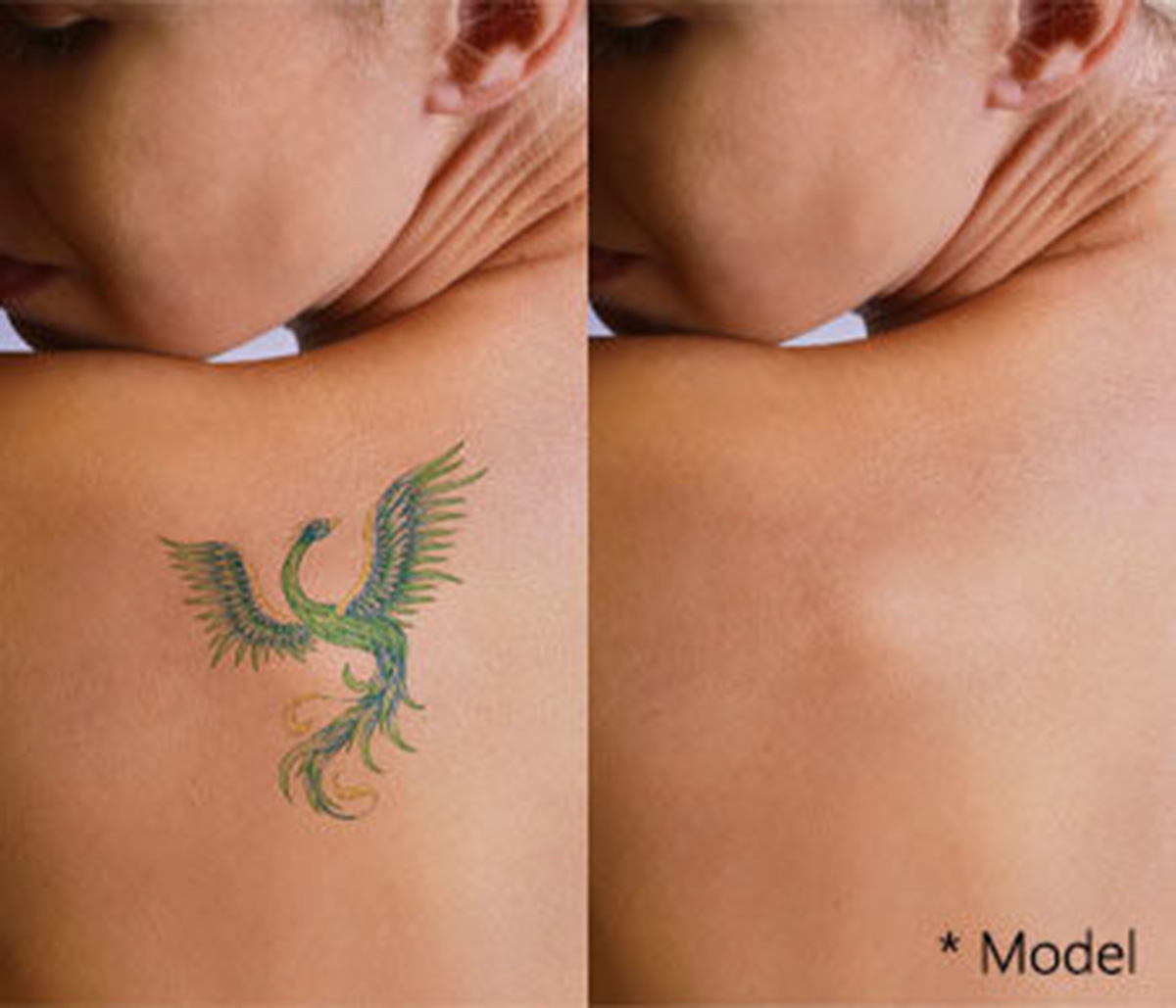 Laser Tattoo Removal  Los Angeles  Pasadena Cosmetic Surgery