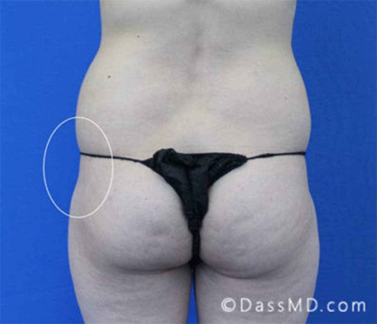 Hip Dips With Fat Transfer Treatment Beverly Hills CA
