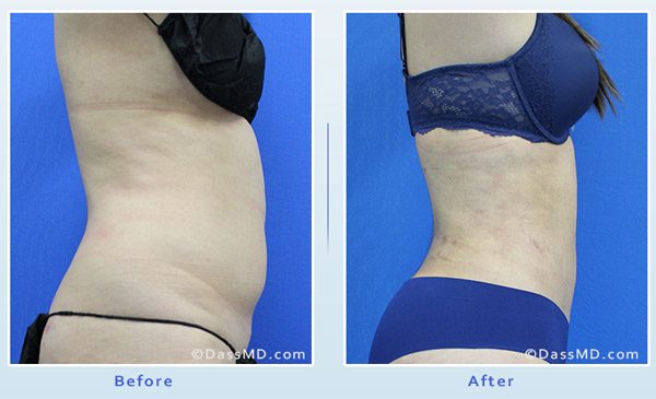 Liposuction Before and After Photo Gallery, Los Angeles, CA