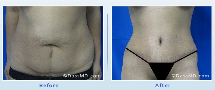 Belly Button Before & After Photos